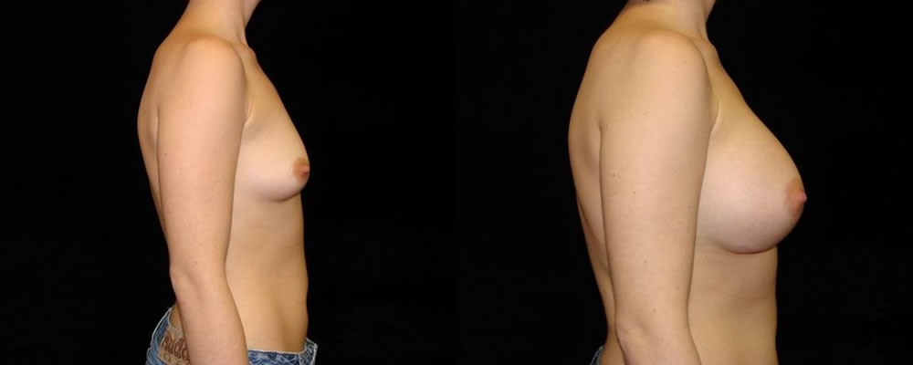 Breast Augmentation Before & After Patient #909