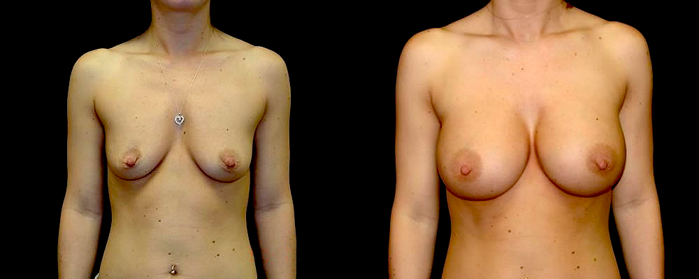 Breast Augmentation Before & After Patient #902