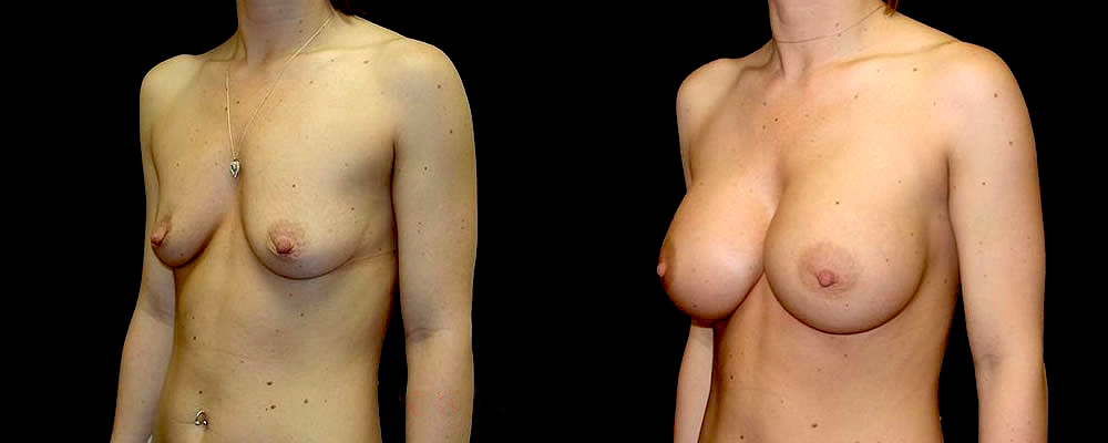 Breast Augmentation Before & After Patient #902