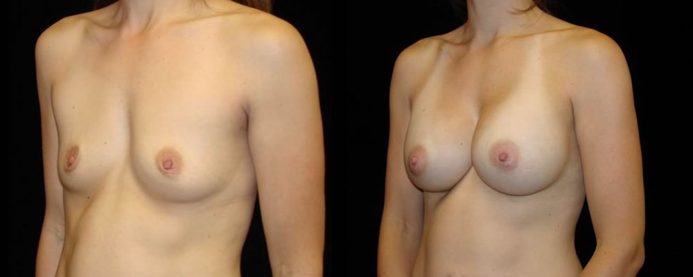 Breast Augmentation Before & After Patient #898