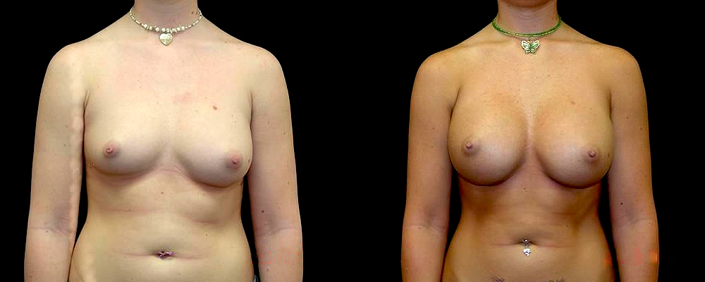 Breast Augmentation Before & After Patient #894