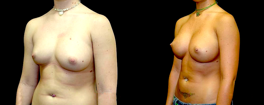 Breast Augmentation Before & After Patient #894