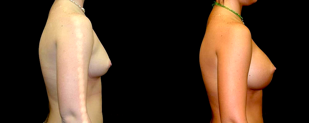 Breast Augmentation Before & After Patient #894
