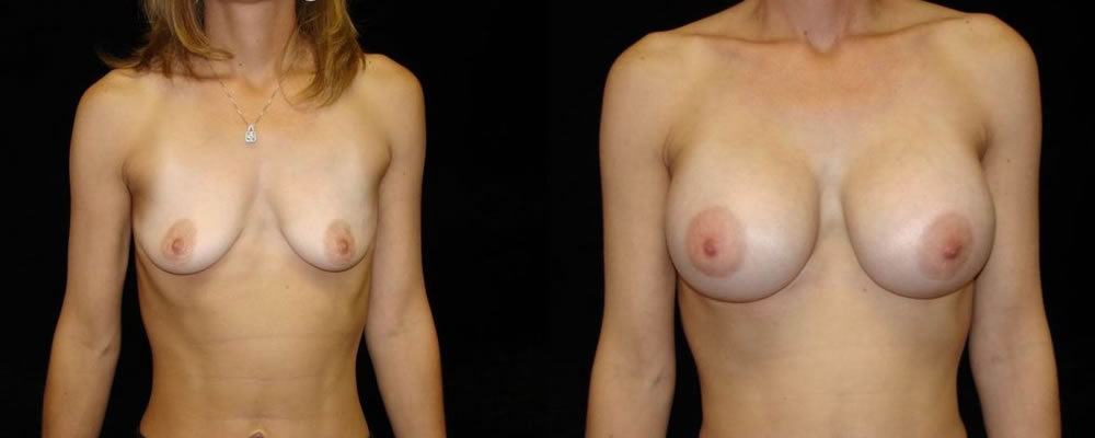 Breast Augmentation Before & After Patient #889