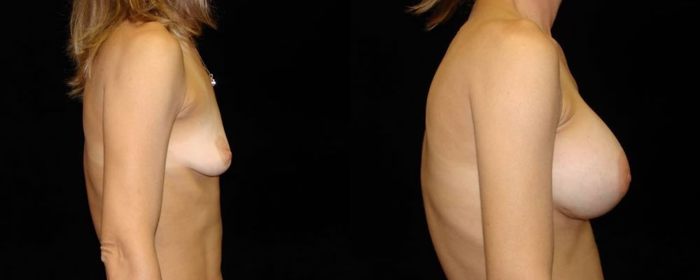 Breast Augmentation Before & After Patient #889