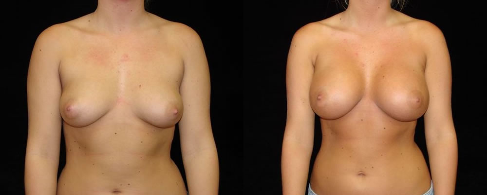 Breast Augmentation Before & After Patient #885