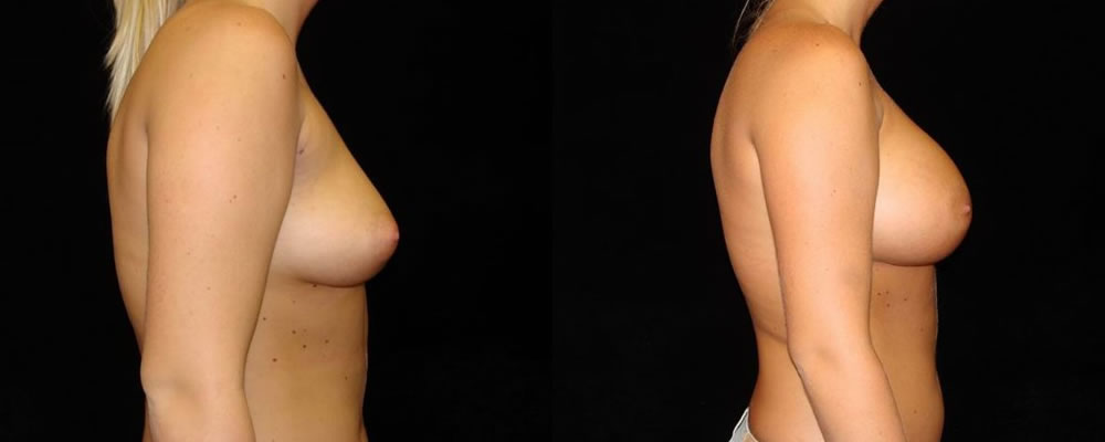Breast Augmentation Before & After Patient #885
