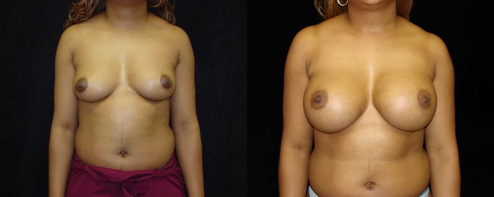 Breast Augmentation Before & After Patient #881