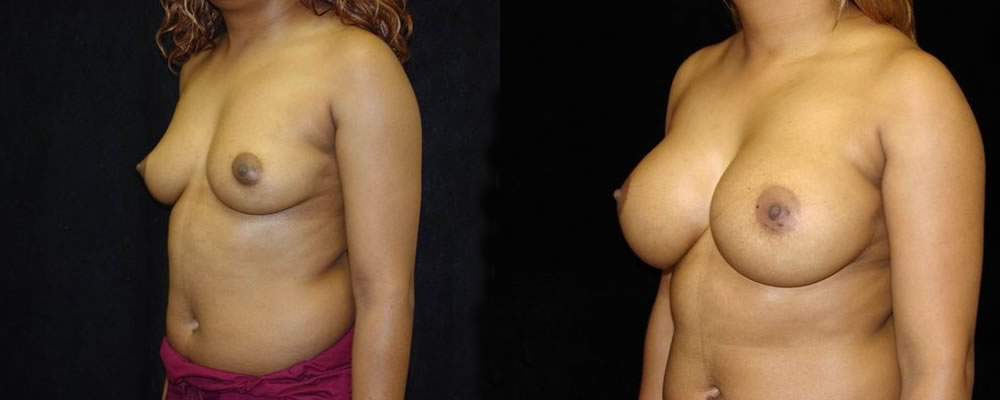 Breast Augmentation Before & After Patient #881