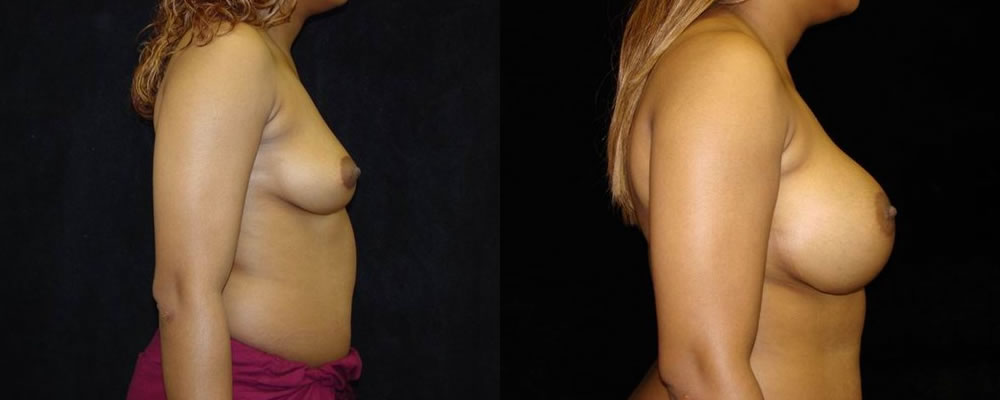 Breast Augmentation Before & After Patient #881