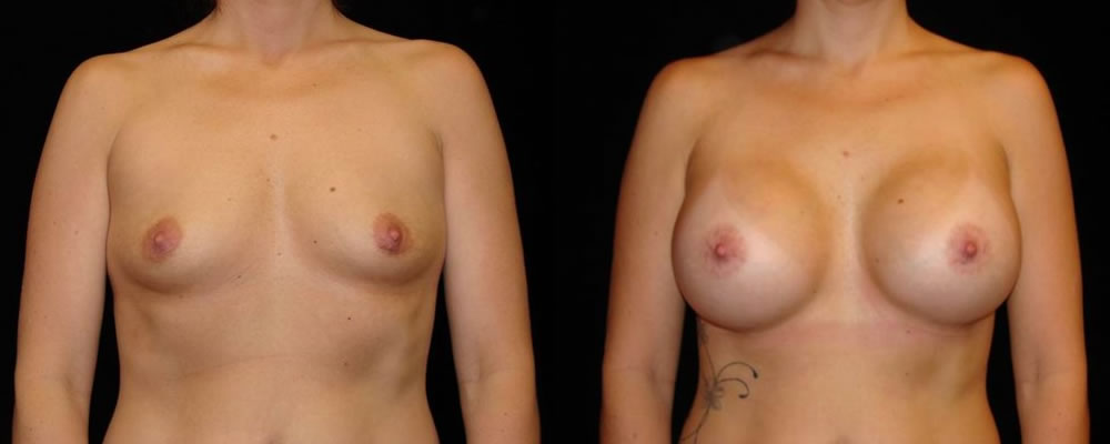 Breast Augmentation Before & After Patient #877