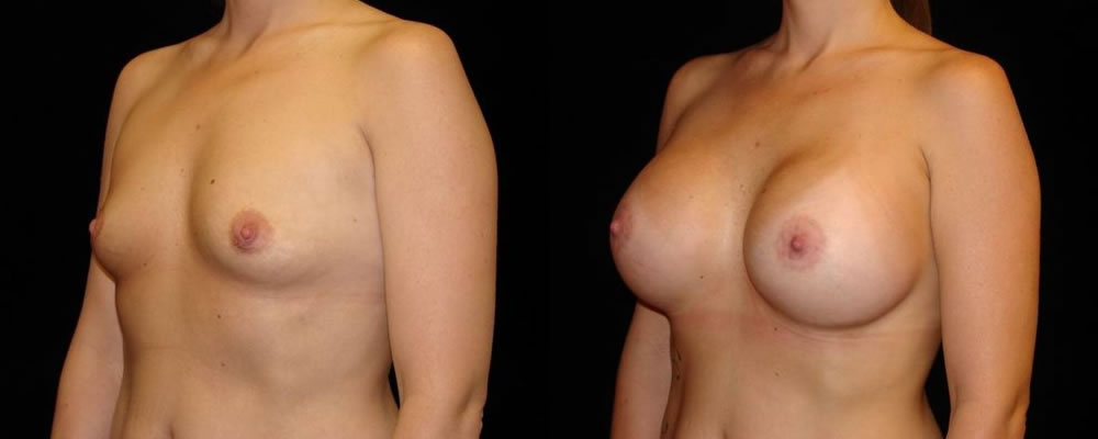 Breast Augmentation Before & After Patient #877