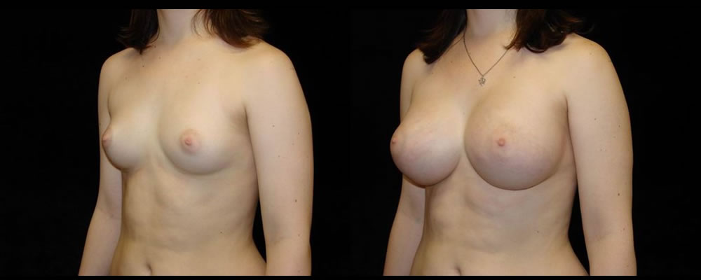 Breast Augmentation Before & After Patient #980