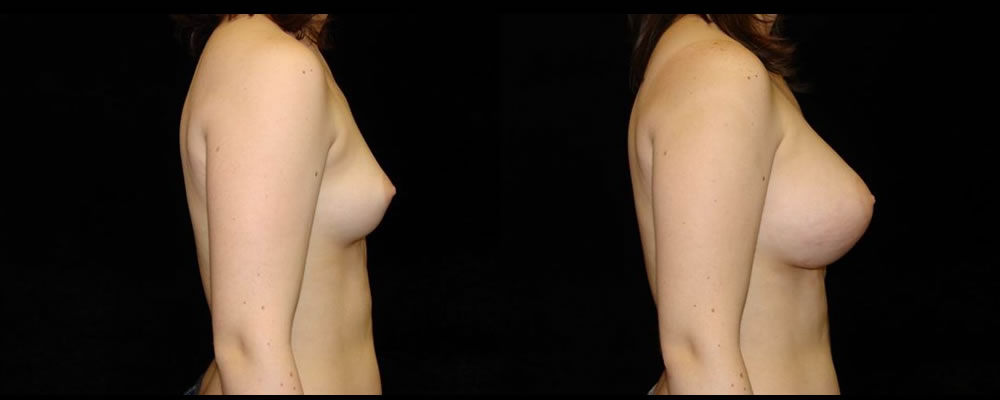 Breast Augmentation Before & After Patient #980