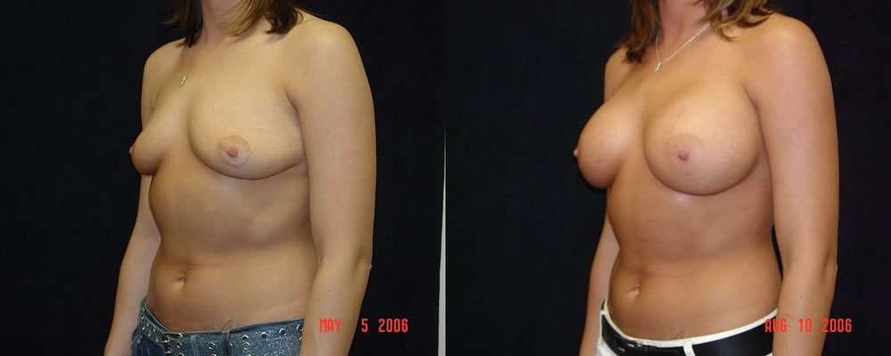 Breast Augmentation Before & After Patient #869