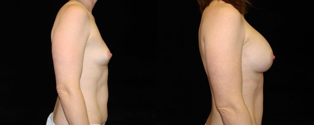 Breast Augmentation Before & After Patient #865