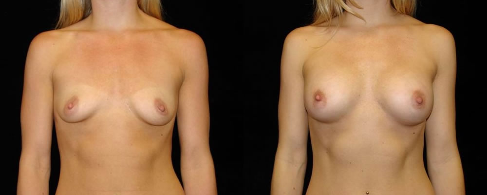 Breast Augmentation Before & After Patient #861