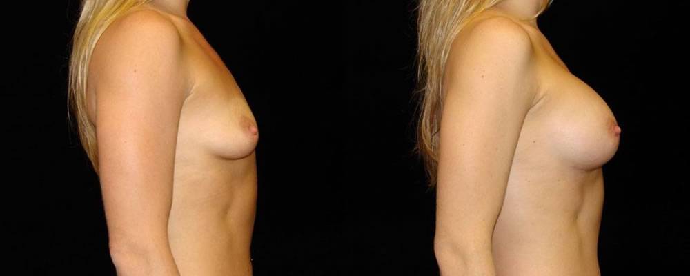 Breast Augmentation Before & After Patient #861