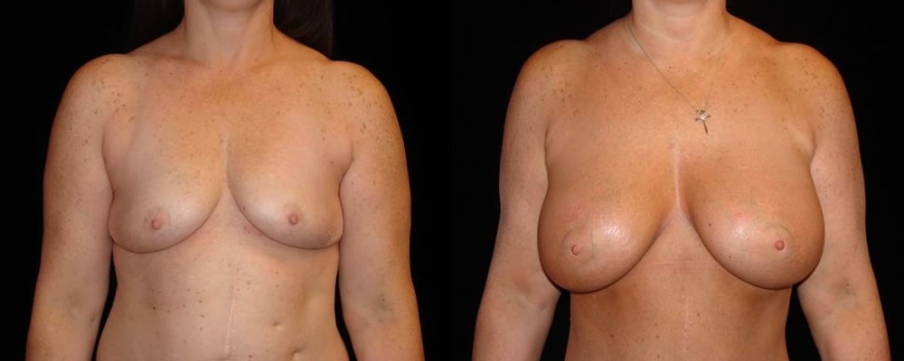 Breast Augmentation Before & After Patient #857