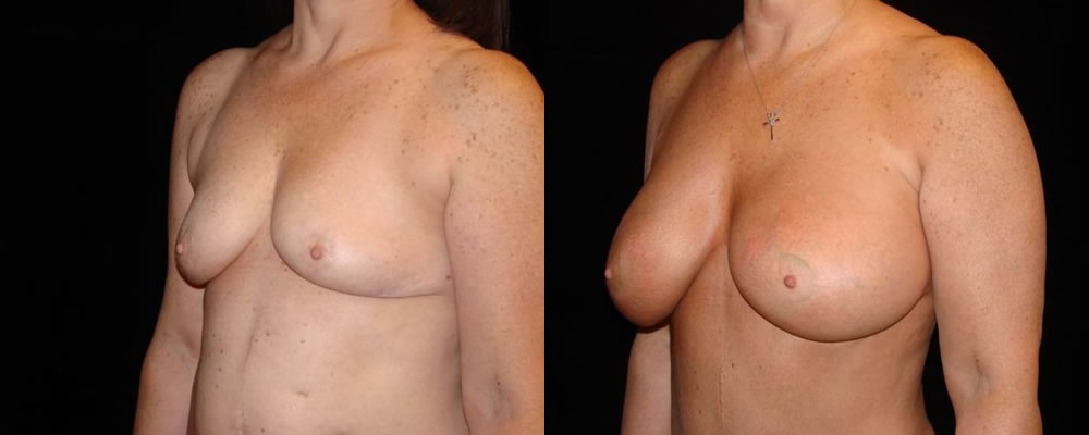 Breast Augmentation Before & After Patient #857