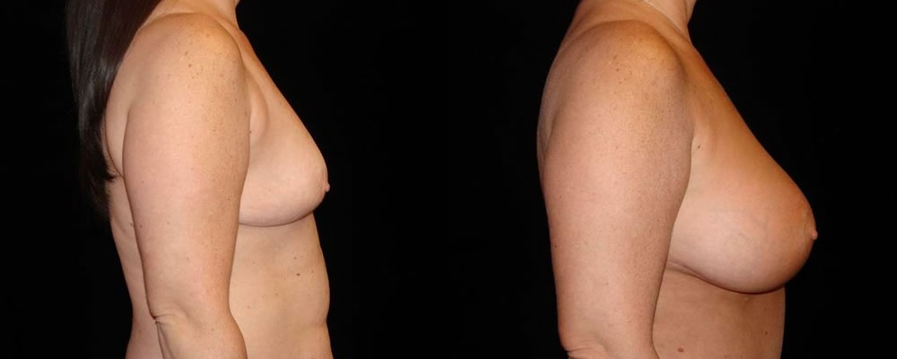 Breast Augmentation Before & After Patient #857