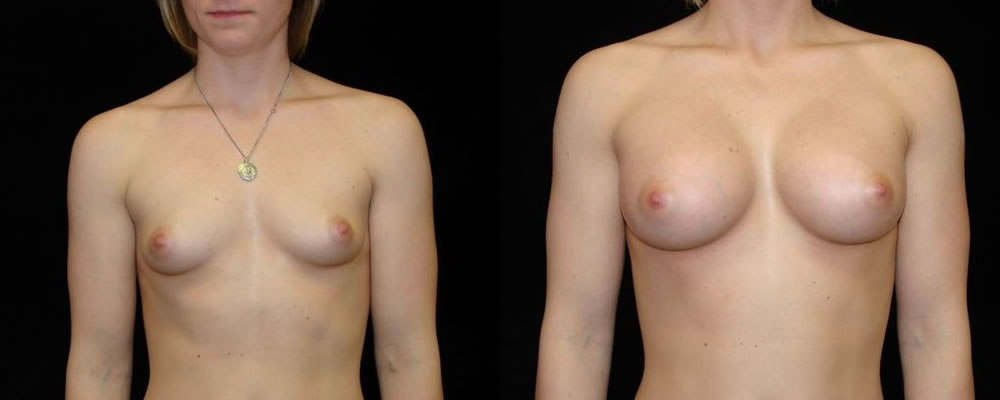 Breast Augmentation Before & After Patient #853