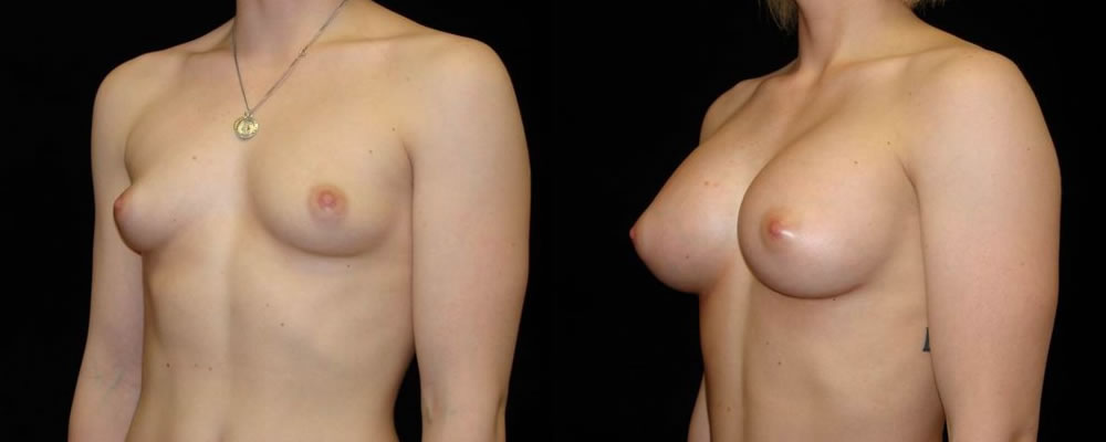 Breast Augmentation Before & After Patient #853