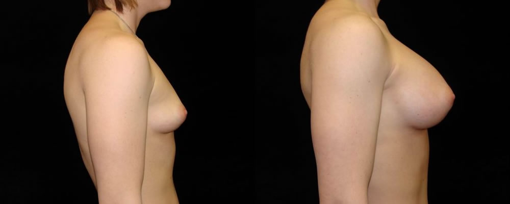 Breast Augmentation Before & After Patient #853