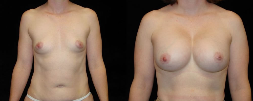 Breast Augmentation Before & After Patient #849