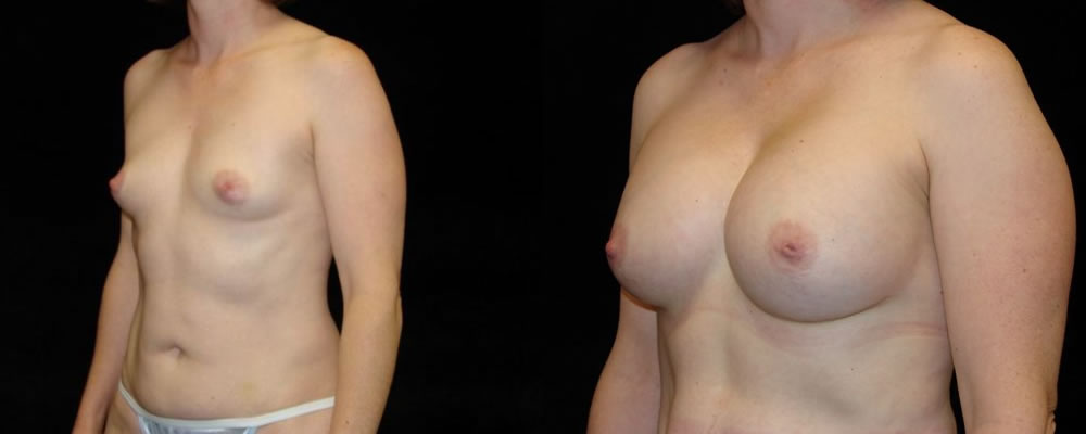 Breast Augmentation Before & After Patient #849