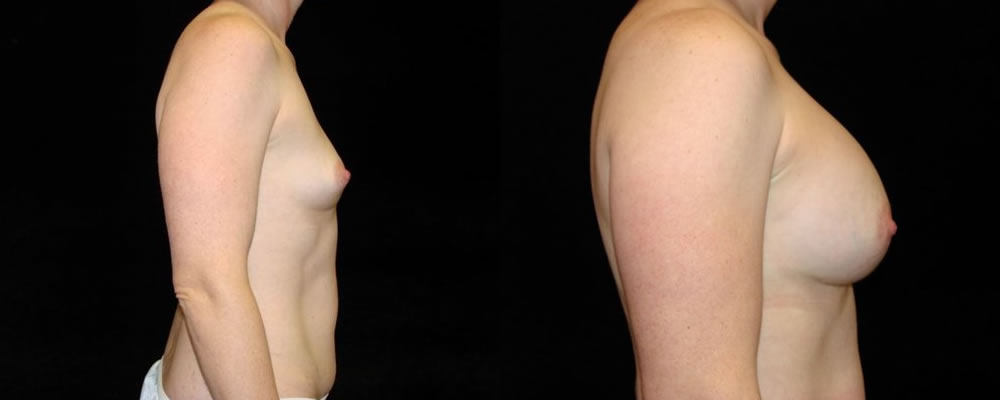 Breast Augmentation Before & After Patient #849