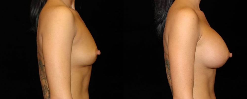 Breast Augmentation Before & After Patient #847