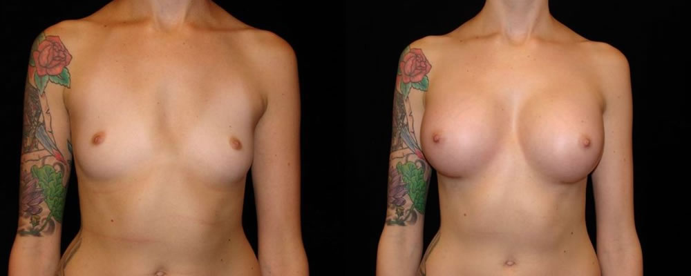 Breast Augmentation Before & After Patient #839