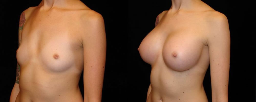 Breast Augmentation Before & After Patient #839