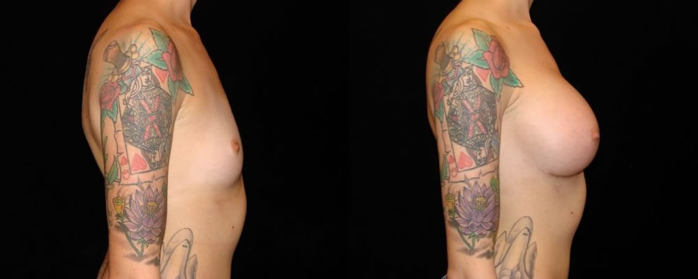 Breast Augmentation Before & After Patient #839