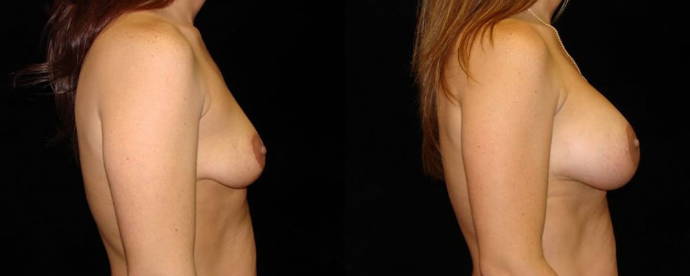 Breast Augmentation Before & After Patient #835