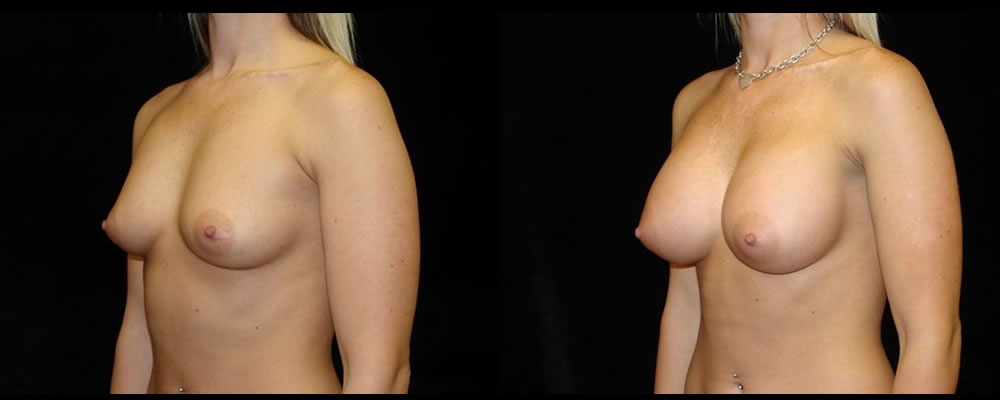 Breast Augmentation Before & After Patient #976
