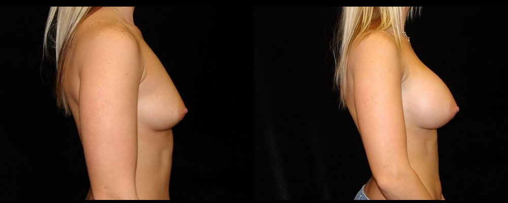 Breast Augmentation Before & After Patient #976