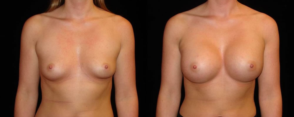Breast Augmentation Before & After Patient #831