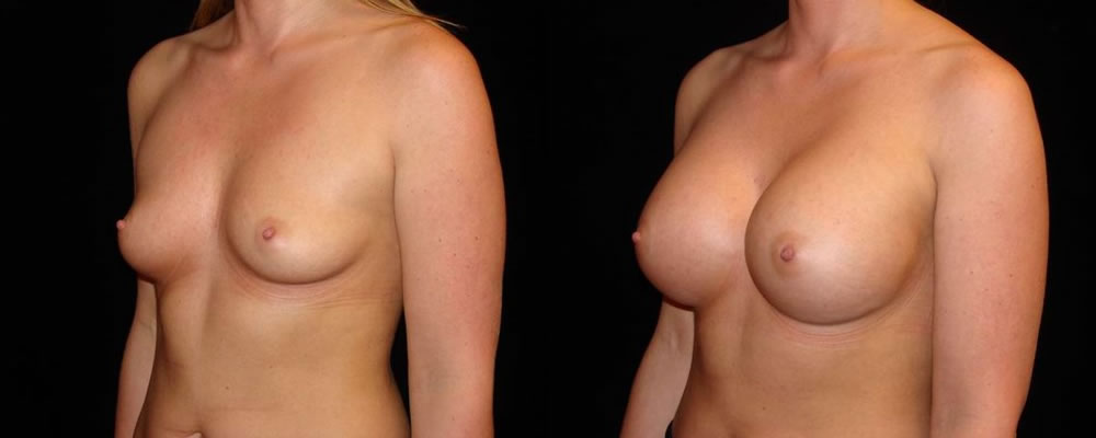 Breast Augmentation Before & After Patient #831