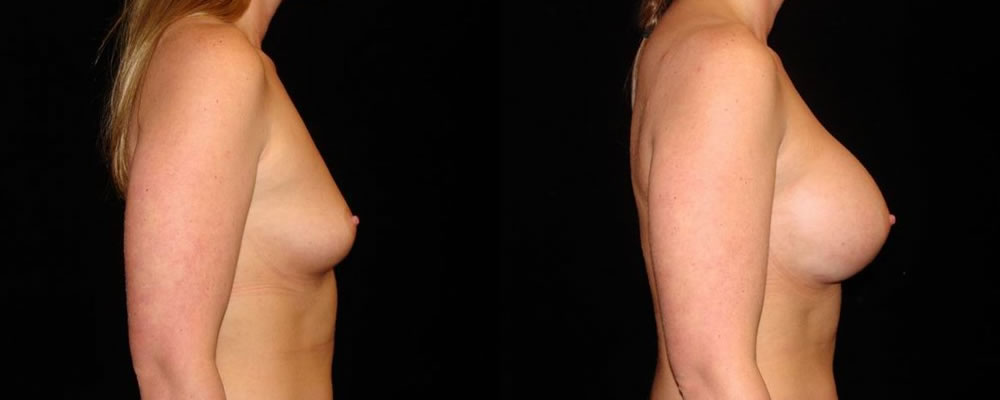 Breast Augmentation Before & After Patient #831