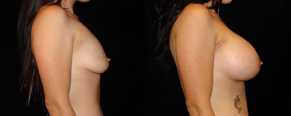 Breast Augmentation Before & After Patient #827