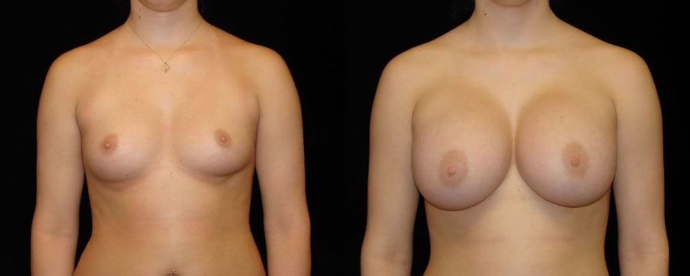 Breast Augmentation Before & After Patient #823