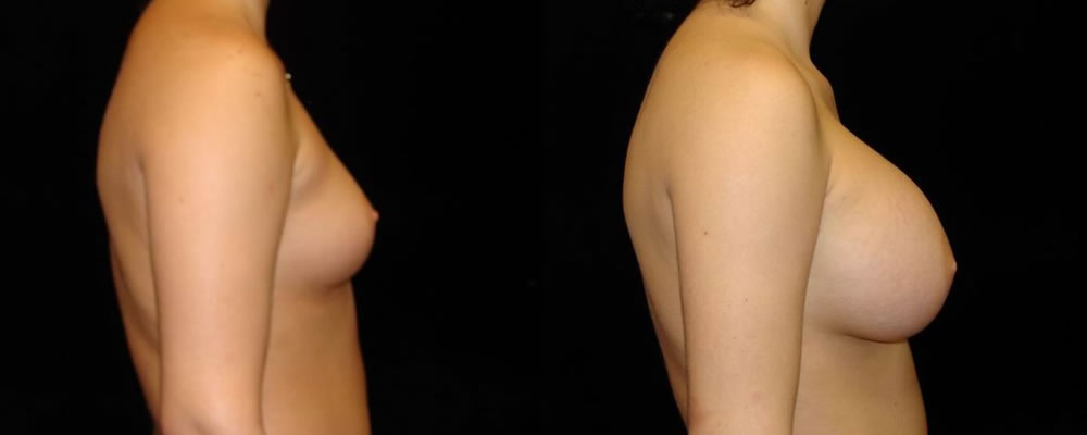 Breast Augmentation Before & After Patient #823