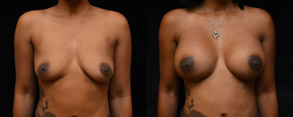 Breast Augmentation Before & After Patient #815