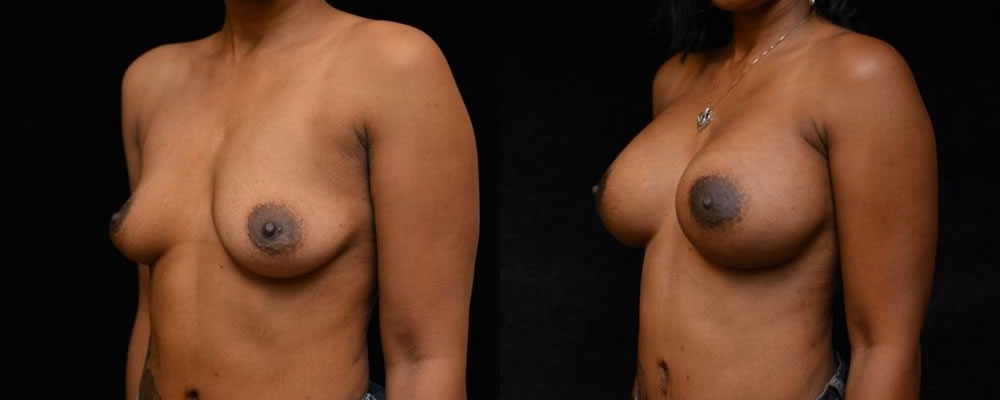 Breast Augmentation Before & After Patient #815