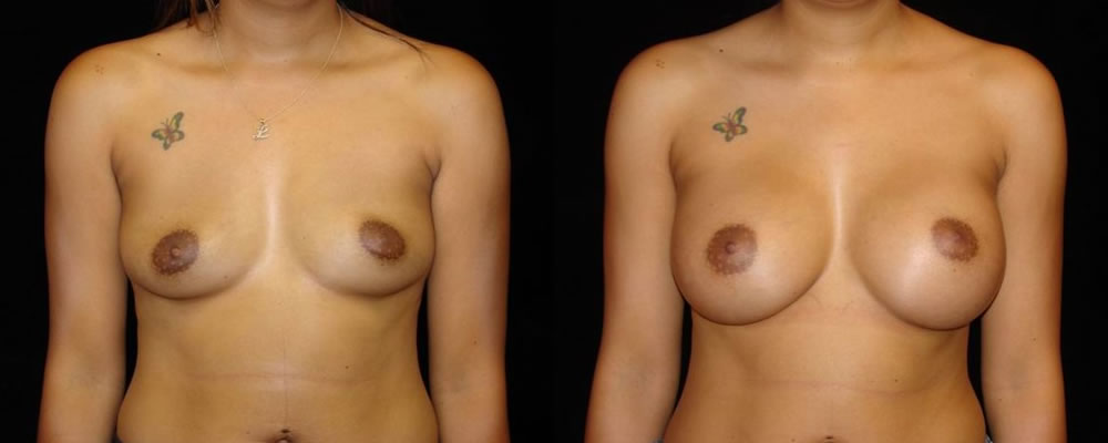 Breast Augmentation Before & After Patient #807