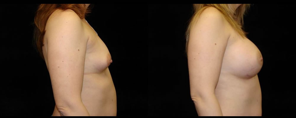 Breast Augmentation Before & After Patient #972