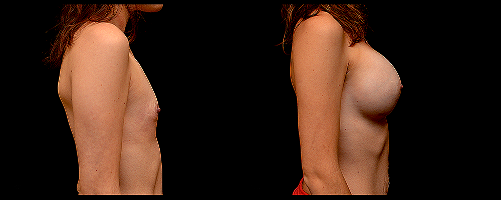 Breast Augmentation Before & After Patient #803