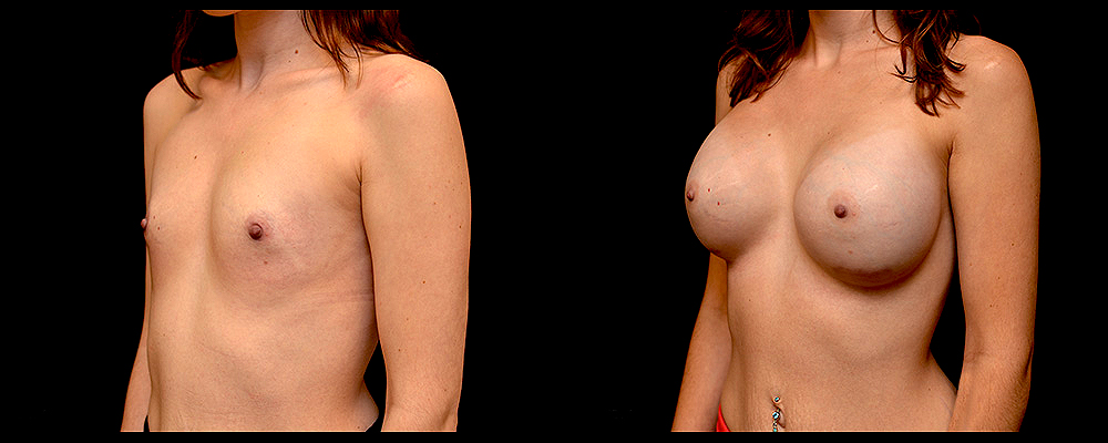 Breast Augmentation Before & After Patient #803